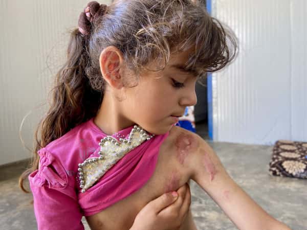Her body is covered with burning scars that she sees every moment, she needs your help to recover!