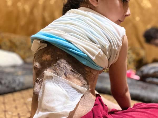 Hala suffers from a rare skin disease