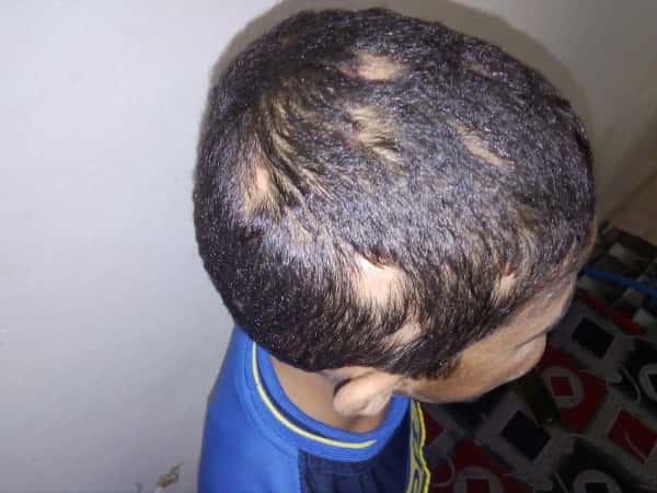 a kid with Alopecia Areata