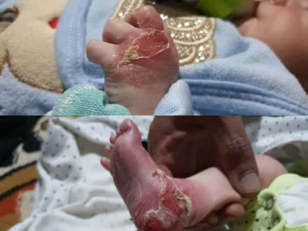 Little Abdul Karim suffers from Pemphigus since birth!