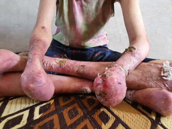 لمرضى الفقاع الجلدي والضمور الدماغي