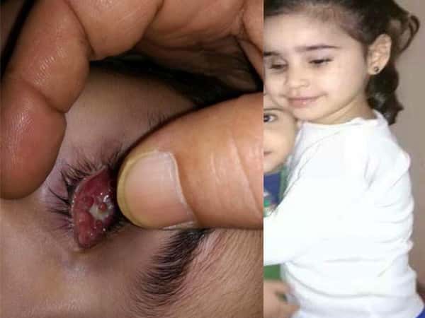 A child in need for implantation of an artificial eye
