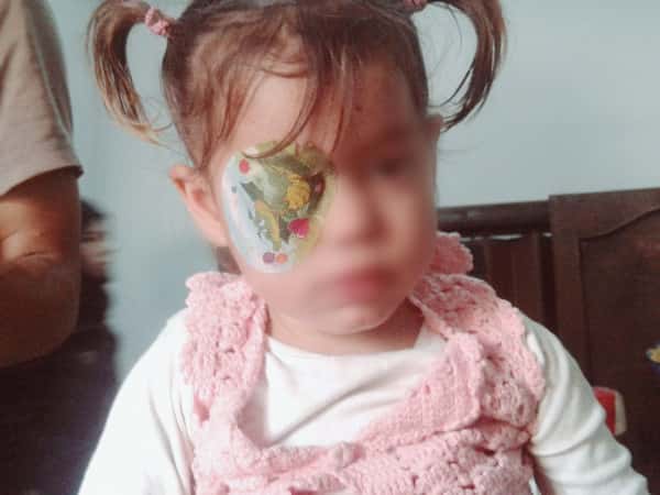 A girl with a damaged cornea