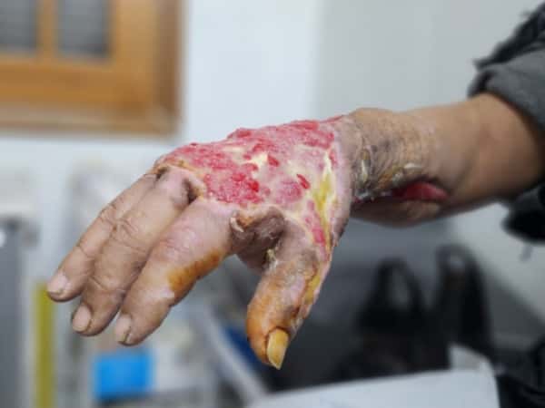 A Second Chance for Mustafa’s Hand