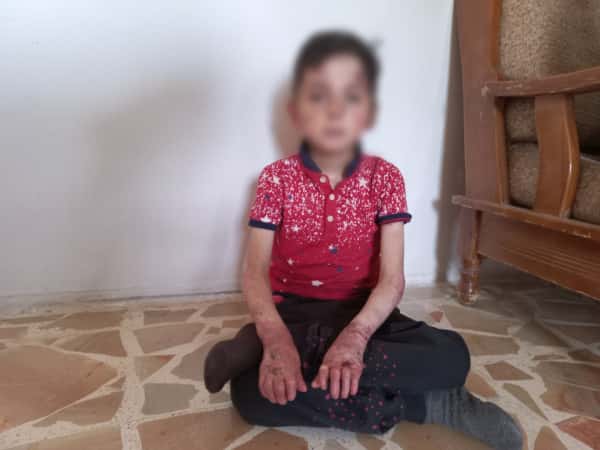 A child suffering from congenital pemphigus